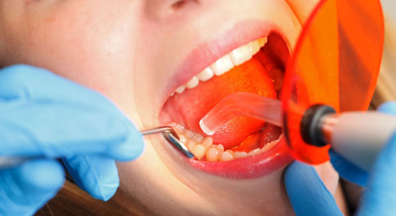 what is dental bonding new